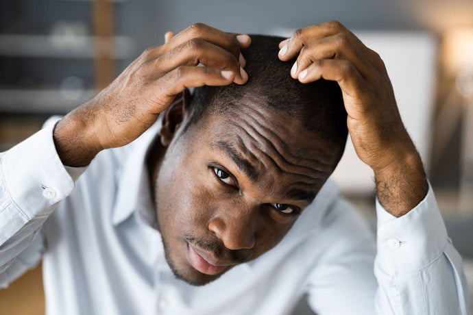 The Top 5 Causes of Hair Loss in Men