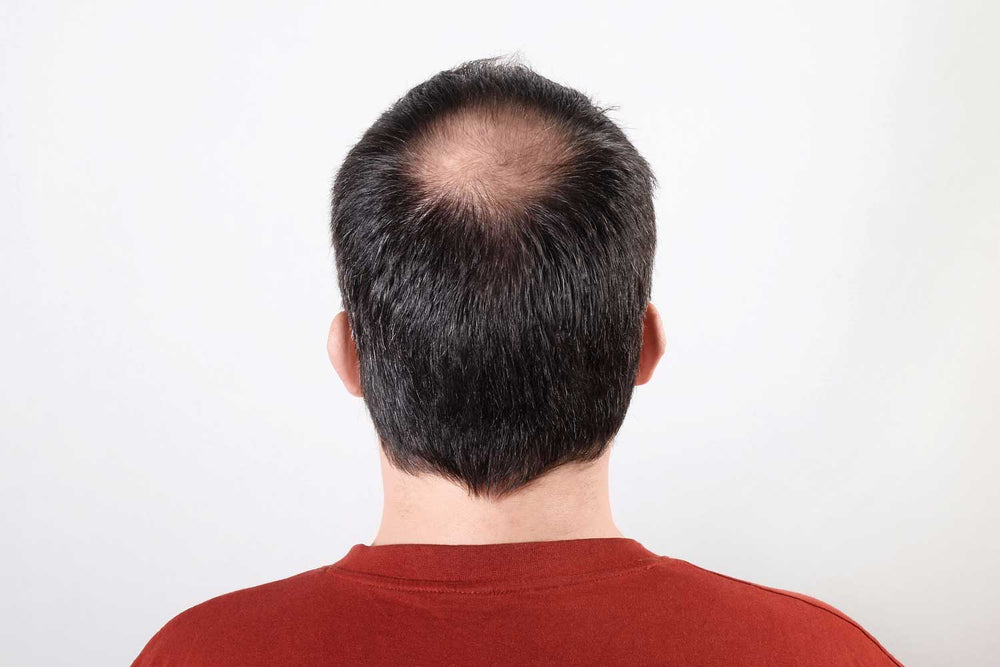 How to Fix a Bald Spot in the Back of Your Head (Alopecia Areata)