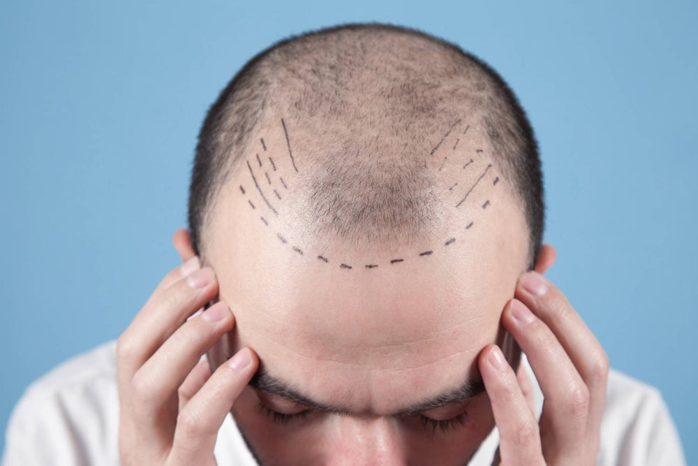 Are Hair Transplants Worth It? Everything You Need to Know