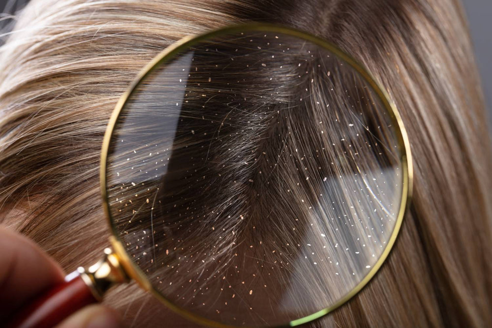 Can Dandruff Cause Hair Loss?